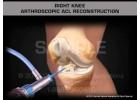 Arthroscopic (Keyhole) ACL Reconstruction by Experts