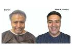 High-Density Results: DHI Hair Transplant in Turkey