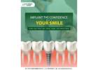 Best Dental Implants Services in Noida 