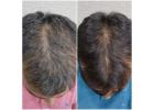 DNA Royal – No.1 Hair Transplant Clinic in Thane.
