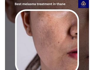 Effective & Safe Melasma Treatment in Thane | DNA Royal Aesthetic Clinic.