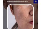 Effective & Safe Melasma Treatment in Thane | DNA Royal Aesthetic Clinic.