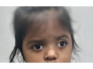 Squint Eye Surgery in Delhi - Dr Anisha Gupta