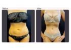 Tummy Tuck Surgery in Delhi - Dr Rajat Gupta