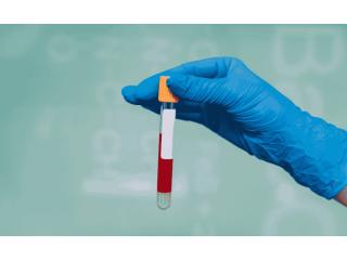Mumps Blood Test in Delhi ( IGG, IGM Test )