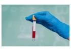 Mumps Blood Test in Delhi ( IGG, IGM Test )