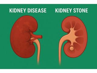 Kidney Disease vs Kidney Stones: What’s the Difference?