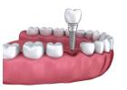 Dental Implants: Types, Procedures, Benefits, and More