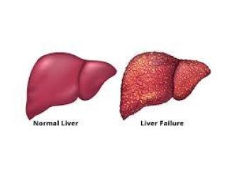 Treatment for Acute Liver Failure in Mumbai | Care Focused on Patient Safety