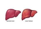 Treatment for Acute Liver Failure in Mumbai | Care Focused on Patient Safety