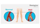Peripheral Artery Disease ICD-10 Codes: Accurate Diagnosis