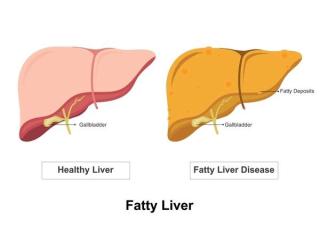 Advanced Fatty Liver Care in Mumbai | Dr. Chetan Kalal