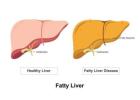 Advanced Fatty Liver Care in Mumbai | Dr. Chetan Kalal