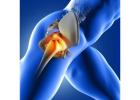 When Do You Need Hip Replacement Surgery? Key Signs to Watch