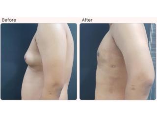 Gynecomastia Treatment in Delhi - Dr Rajat Gupta
