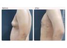 Gynecomastia Treatment in Delhi - Dr Rajat Gupta