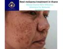 DNA Royal: Your Destination for the Best Melasma Treatment in Thane.
