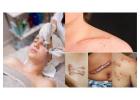Want Trusted Scar Removal Services Near You in Los Angeles?