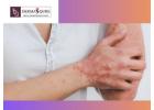 Get Expert Skin Psoriasis Treatment In Bangalore - Dermaqure