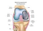 Ease Your Knee Pain with Partial Knee Replacement Surgery