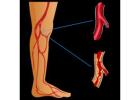 PAD Treatment – Advanced Care Options for Peripheral Artery Disease Relief