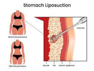 Liposuction Surgeons London | Harley Surgical Group