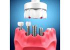 Dental Implant Therapy: A Long-Lasting Solution for Missing Teeth