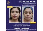 Looking for the Best Acne Treatment in Thane? Choose DNA Royal.