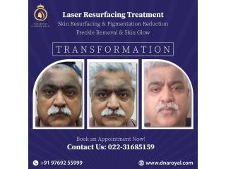 Transform Your Skin with Laser Resurfacing Treatment in Thane at DNA Royal.
