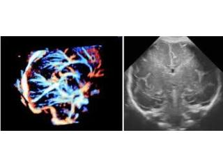 Fetal Neurosonography test service in Sonipat | Fetal India