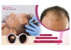 Looking for the Best Hair Loss Treatment in Bangalore - Dr. Priya Skin and Hair Clinic