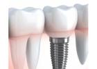 Best Dental Implants Melbourne by Experienced Dentists 