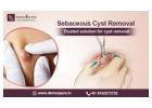 Affordable Sebaceous Cyst Removal Cost In Bangalore - Dermaqure