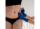 Safe And Precise Awake Liposuction Branson MO
