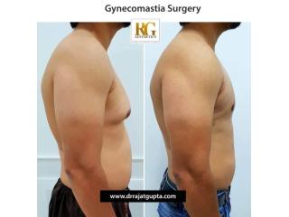 Common Side Effects and Risks of Gynecomastia Surgery