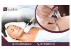 Affordable Cost Of Microneedling Treatment in Bangalore - Dermaqure
