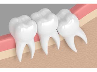 Dental implant bridge