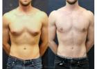 Gynecomastia in Kolkata – Male Breast Reduction Treatment