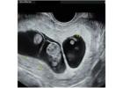 Best Twin pregnancy scan test | Fetal India