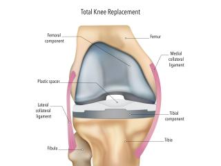 Knee Replacement Surgery for Pain Relief & Restoring Mobility