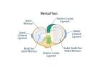 Relieve Knee Pain with Medial Meniscus Tear Surgery