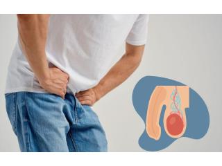 Best Varicocele Treatment: Safe, Effective & Advanced Care Options