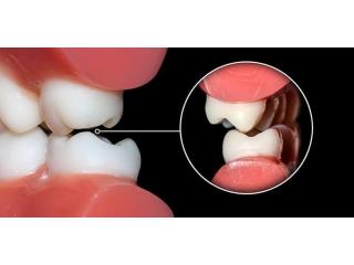 Root Canal Treatment In Jaipur