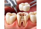 Who Is the Best Dentist Near Me in Delhi? | The Dental Roots