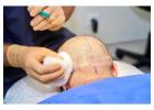 Best Hair Transplant Doctor in Delhi
