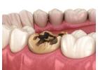 Can a Dead Tooth Be Saved? Causes & Treatments