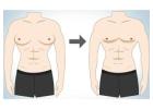 Advanced Gynecomastia Surgery in Mumbai - Get Natural Results