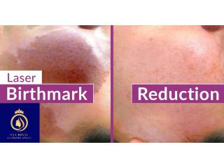 Professional Laser Birthmark Removal in Thane | DNA Royal Clinic.