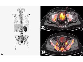 Precision Cancer Detection with Advanced FAPI PET-CT at Picture This Mumbai