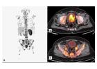 Experience Precision Cancer Staging with FAPI Pet CT at Picture This 